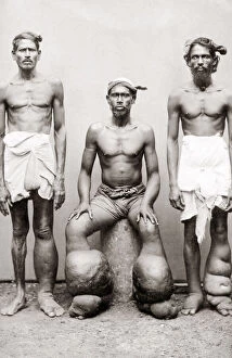 Men with Lymphatic filariasis, or elephantiasis swollen limbs