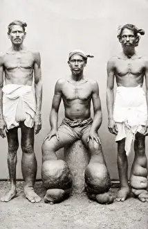 Cultural Prints: Men with Lymphatic filariasis, or elephantiasis swollen limbs
