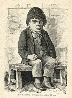 Patients Prints: Mentally deficient man - aged 35