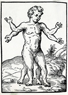 Anomalous Collection: Multi-Limbed Child / 1560