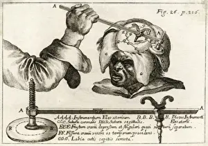 Trepanning Prints: Operation on Skull