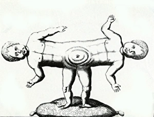 Anomalous Collection: Siamese Twins / C18Th