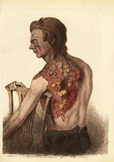 Shoulder Prints: Soldier with an abscess from a gunshot wound to the shoulder