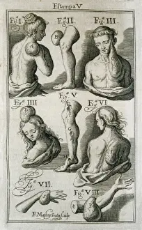 Surgical Prints: SUREZ de RIBERA, Francisco (s. XVIII). Spanish