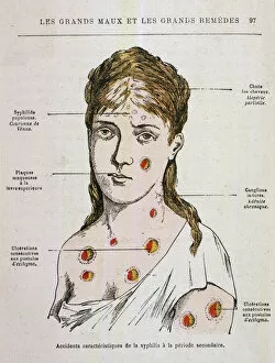 Appears Collection: SYPHILIS / 1883