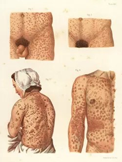 Scientific Collection: Syphilis symptoms on the body