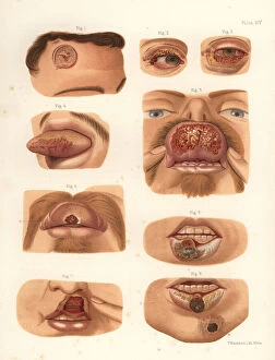 Sinclaire Gallery: Syphilitic chancres on the face