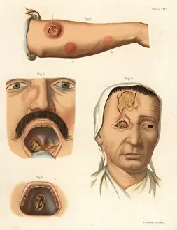 Ackermann Gallery: Tertiary period syphilis symptoms on the body