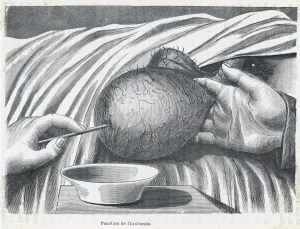 Removing Gallery: Testicle Growth Drained