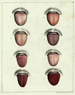 Images Dated 16th April 2012: The tongue of a yellow fever sufferer