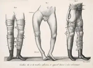 Treating Bow Legs (2)