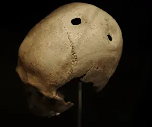 Scandinavia Prints: Trepanned skull of a man. 3500-3400 BC. Denmark