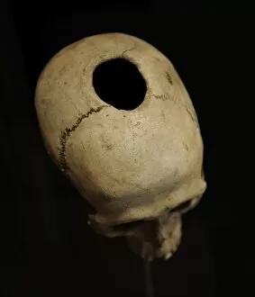 Neolithic Gallery: Trepanned skull. Neolithic Period. Denmark