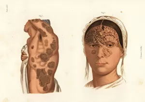 Auguste Gallery: Tubercular syphilis symptoms on the body