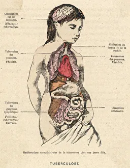 Tuberculosis Collection: Tuberculosis Sufferer