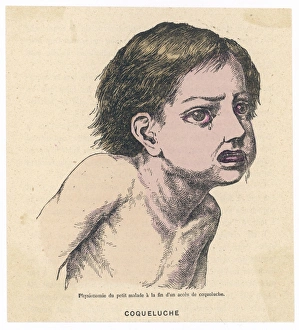 Affect Gallery: Whooping Cough / 1883