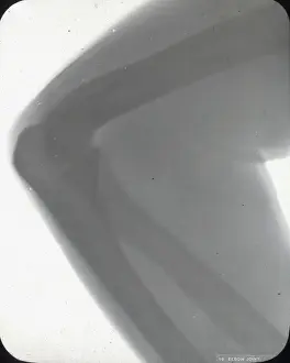 X Rays Prints: X-Ray - Elbow Joint