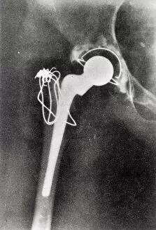 Images Dated 4th September 2013: X-ray hip joint replacement