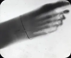X-Ray - Human Foot