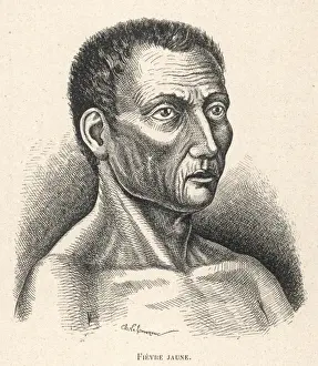 Yellow Fever Victim